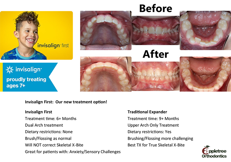 Invisalign First  Dr. Patricia Timmeny
